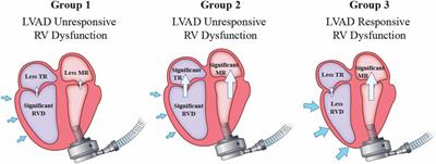 Role of the mitral valve in left ventricular assist device pathophysiology